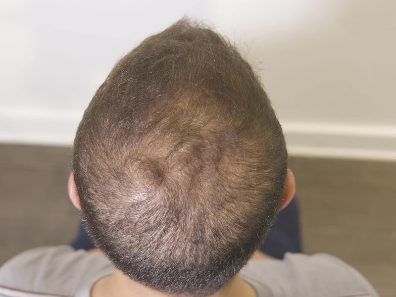 Hairy moles may contain cure for baldness: Study Hairy moles may contain cure for baldness: Study